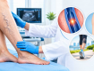 Varicose Veins Treatment Without Surgery Chennai: Treatment Guide
